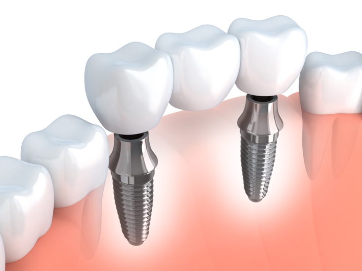 Are You A Candidate For Dental Implants?