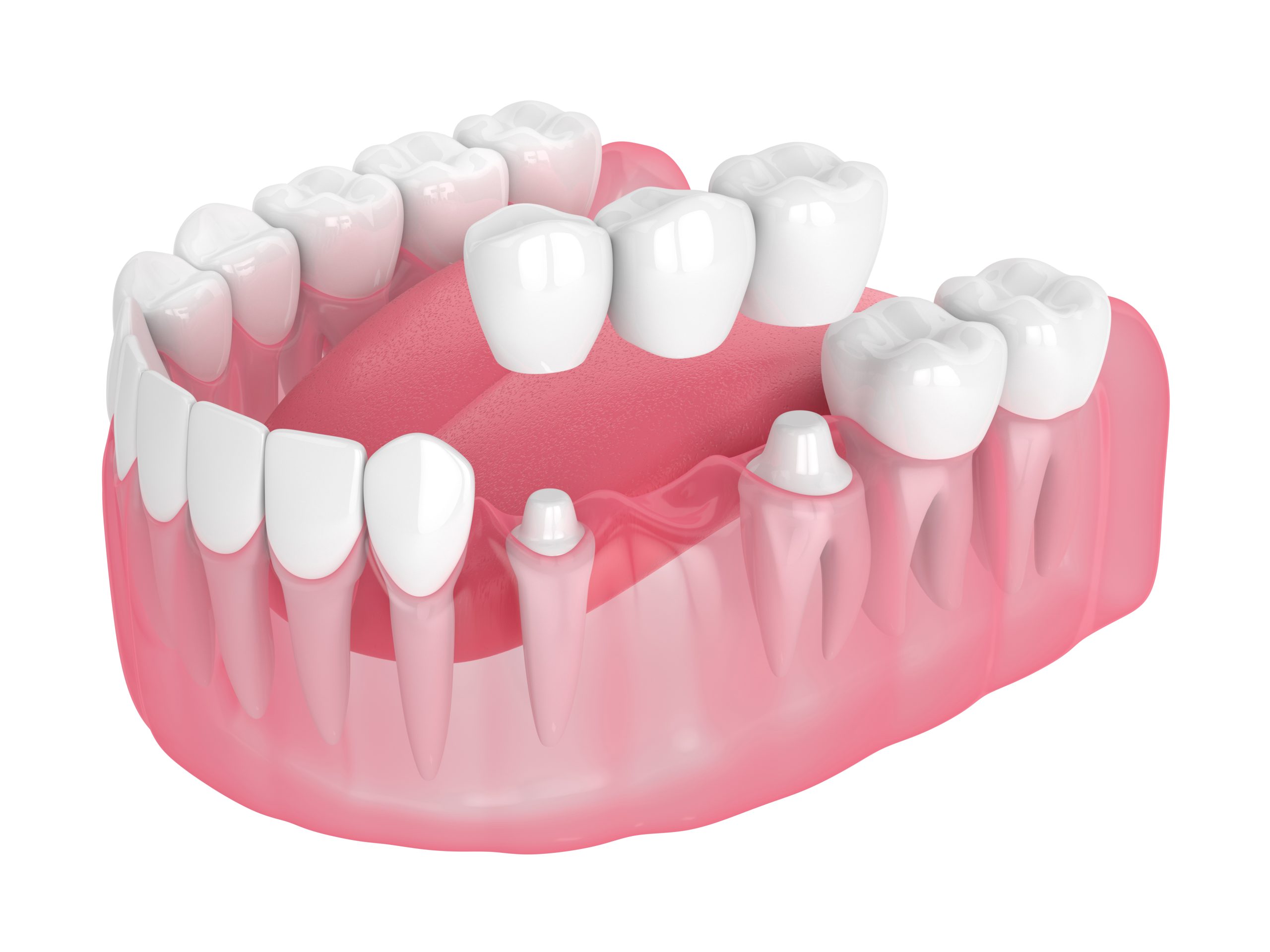 3d render of jaw with dental bridge