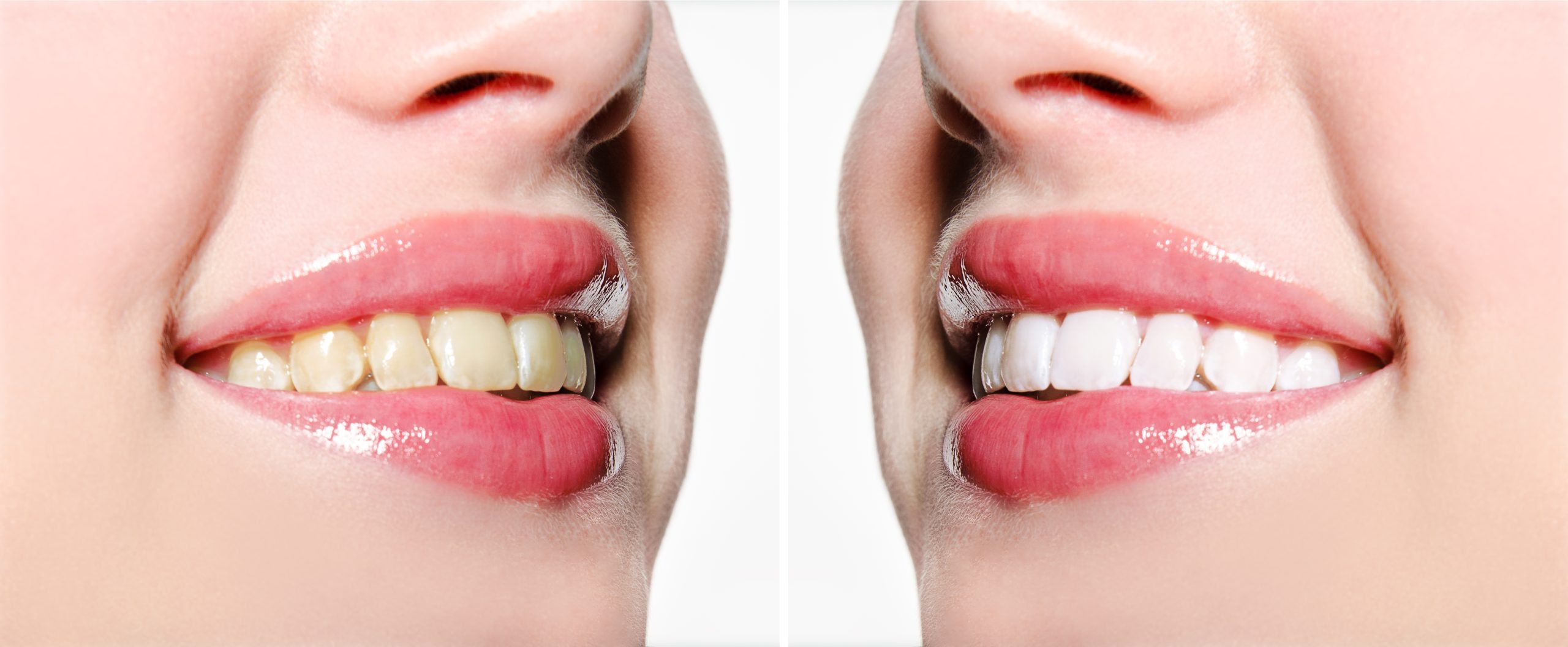 Woman smile teeth before and after whitening