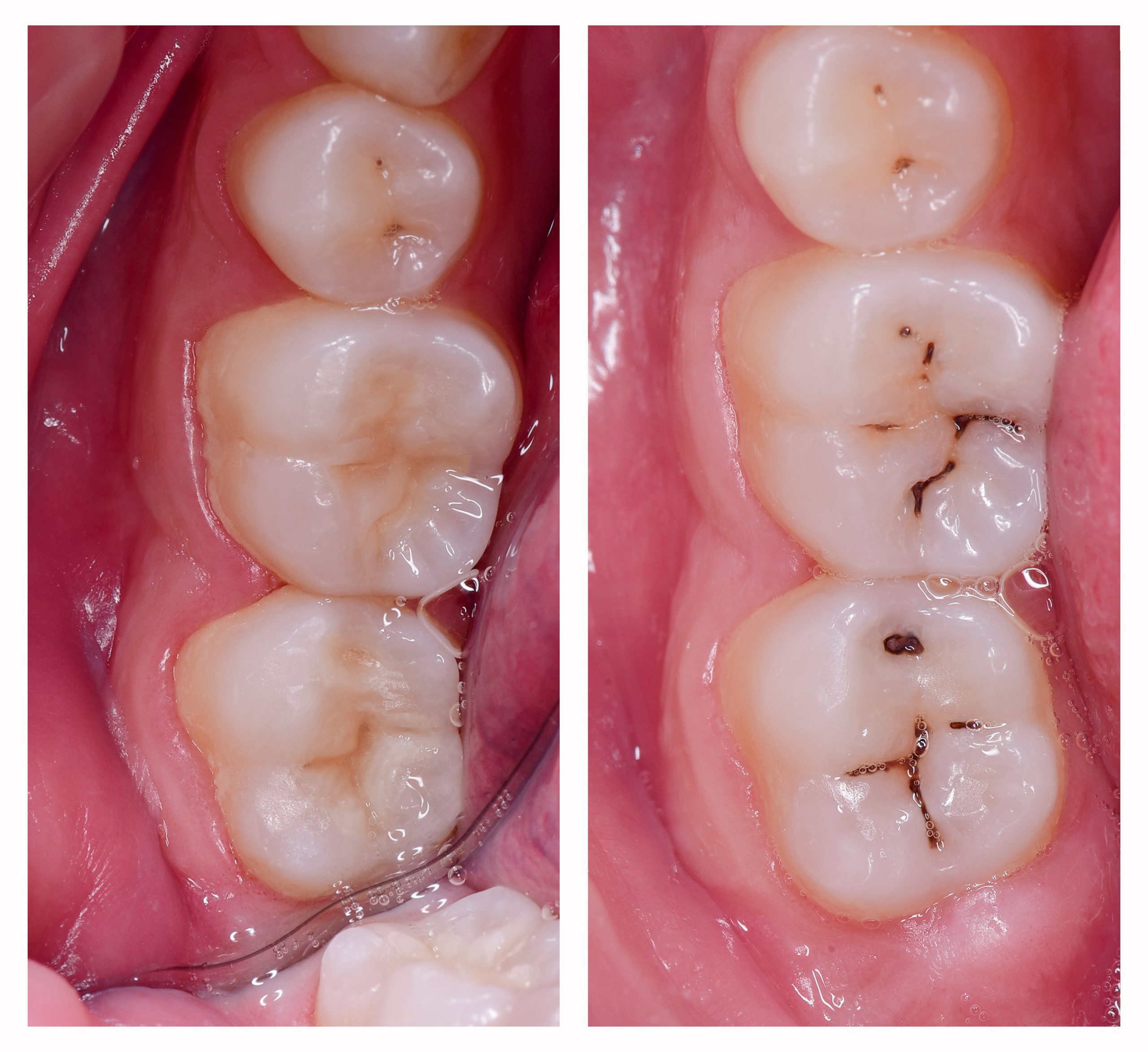 cavity treatment by direct composite restoration