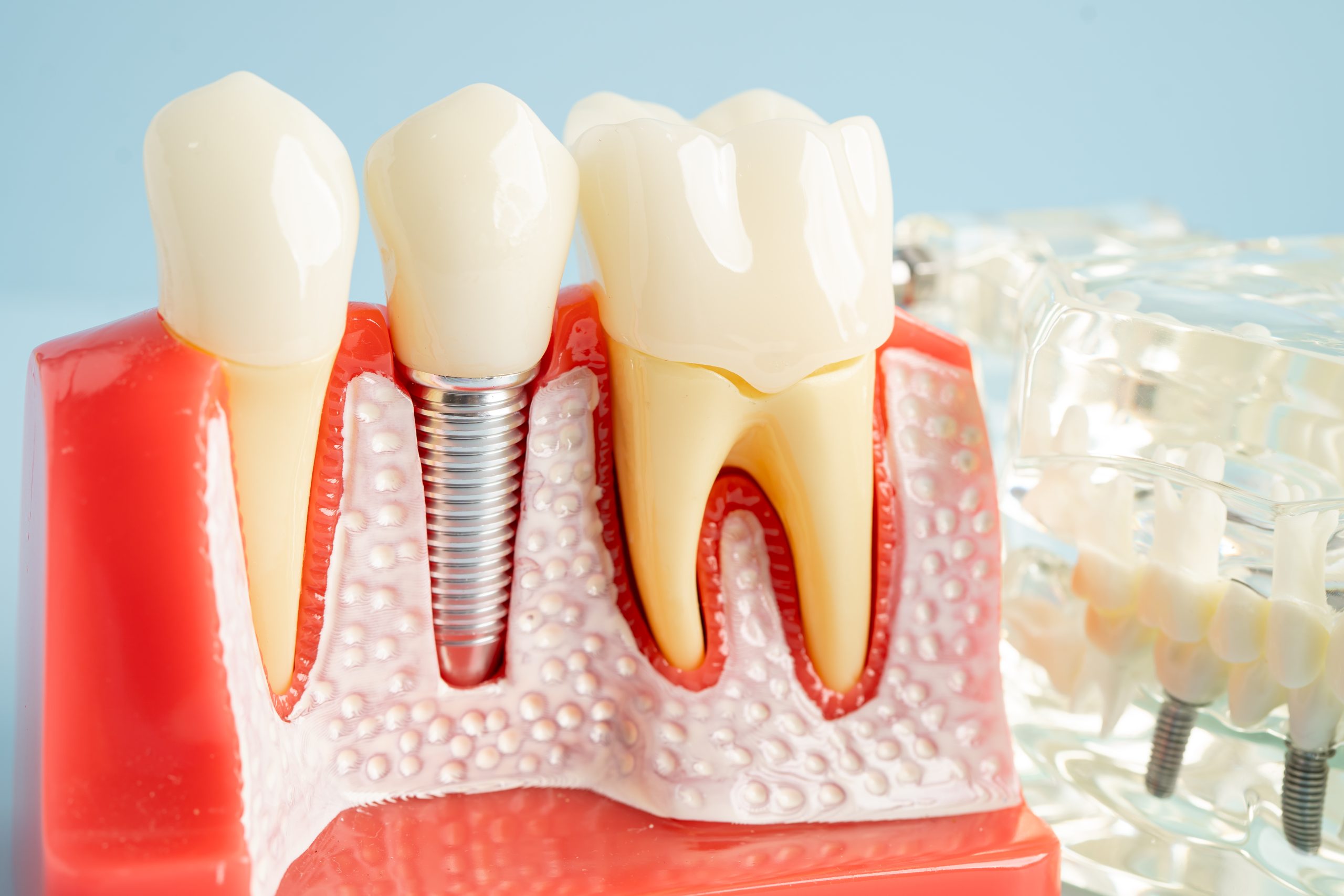 Dental implant, artificial tooth roots into jaw, root canal of d