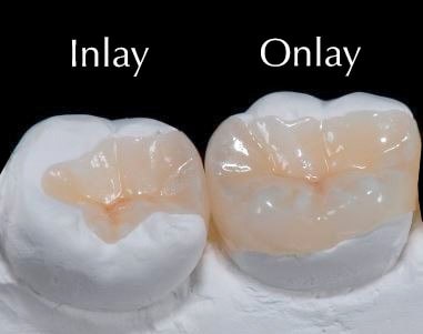 inlay-onlay