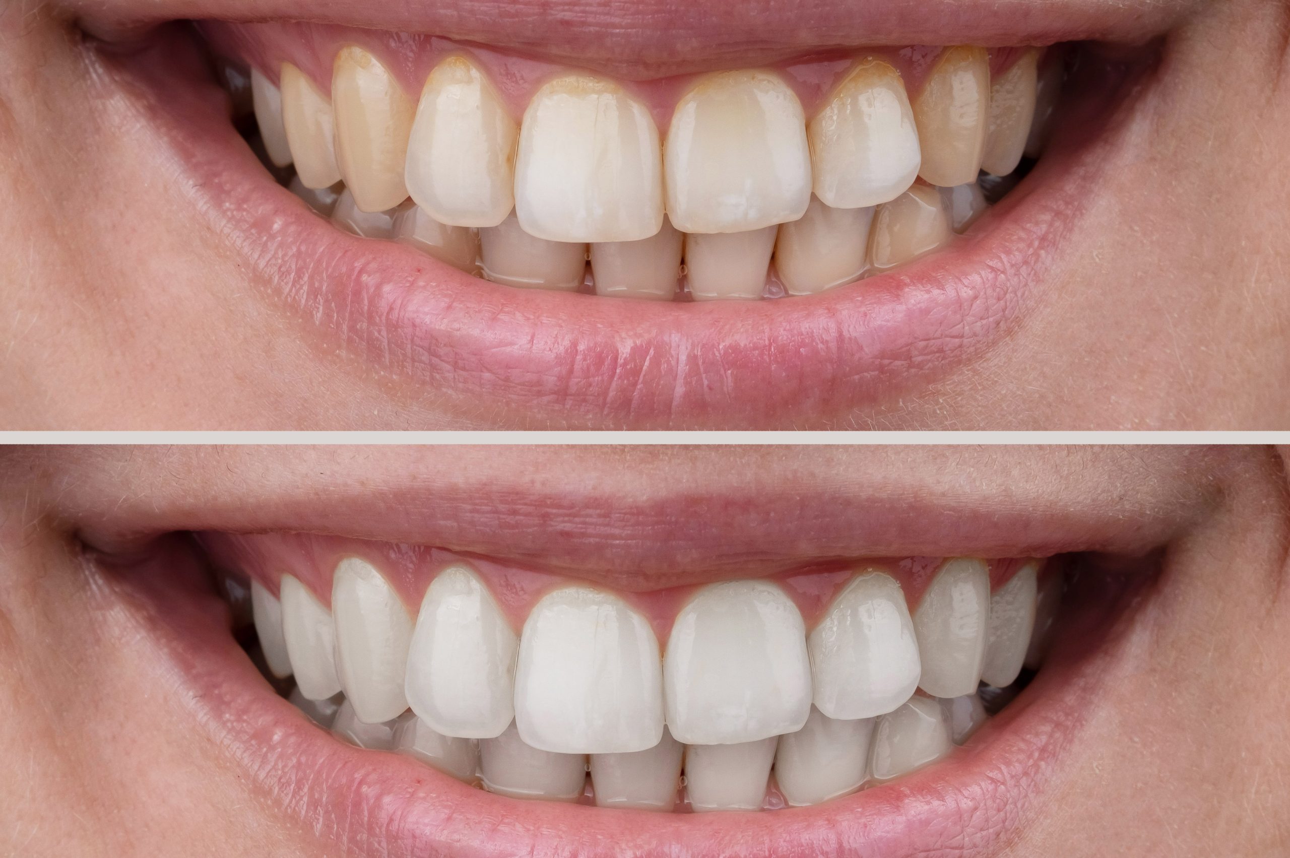 Close-up of a woman's smile before and after teeth whitening.