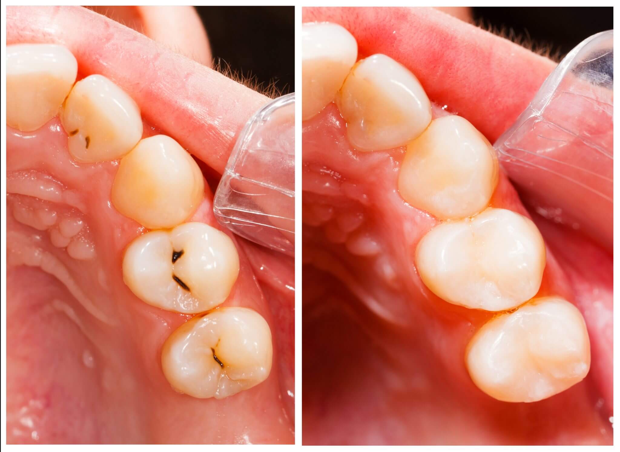 white-tooth-filling